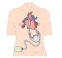 LVAD