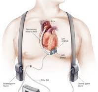 LVAD